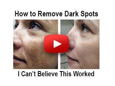 Beverly Hills MD – Dark Spot Remover (Expired)